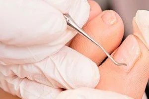 Podologie Lerad Krefeld 8 Medizinische Fußbehandlung Nagelkorrektur